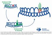 Chewing habits determine early deterioration of dental implants