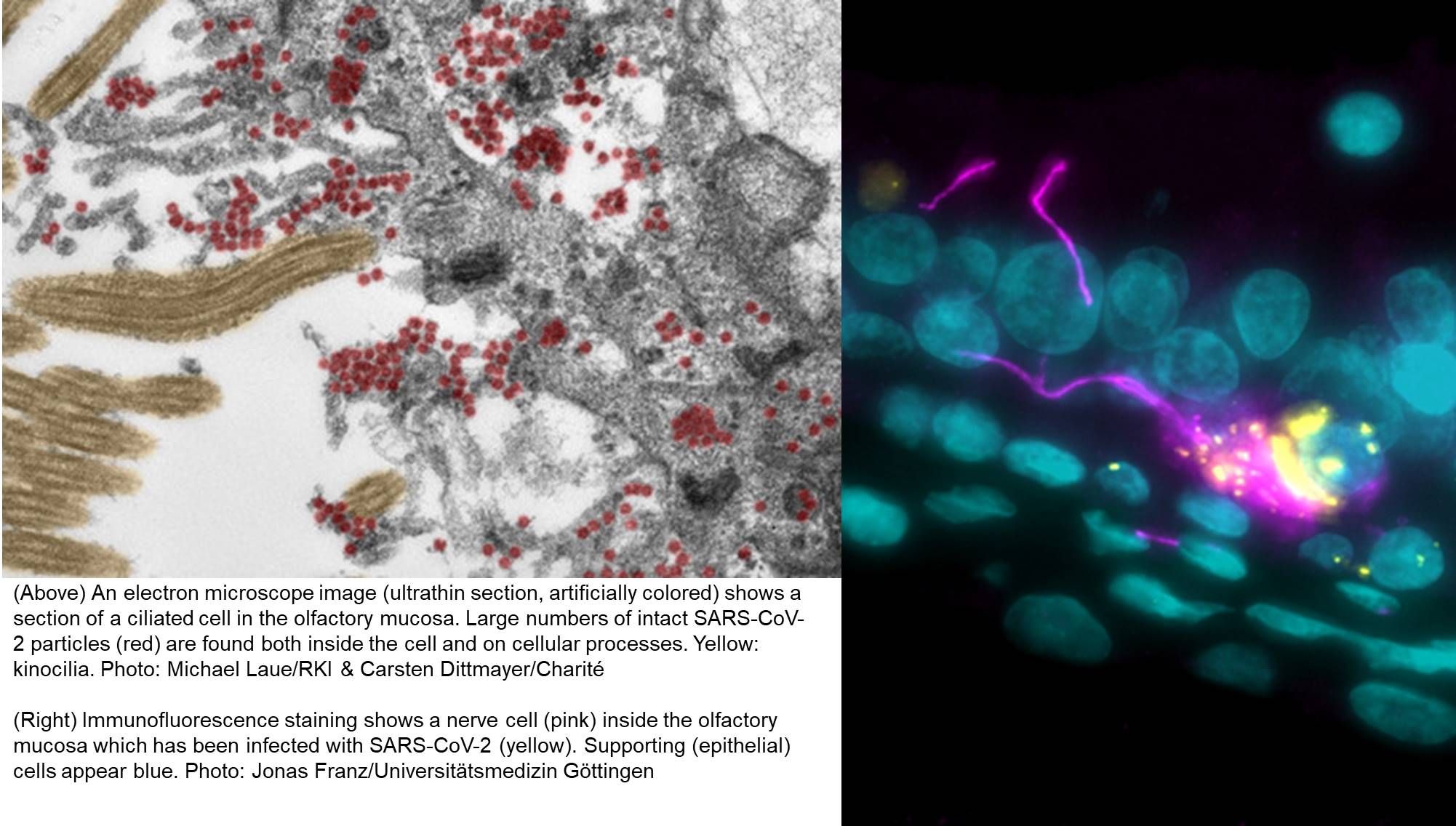 How SARS-CoV-2 enters brain