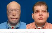 Surgeons at NYU Langone Medical Center perform the most extensive face transplant to date