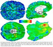 Tau-PET detection early in Alzheimer&#039;s disease