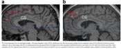 Hallucination induced brain morphology changes revealed!