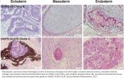 Urine-derived stem cells predict patient response to cholesterol-lowering drugs