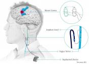 Vagus nerve stimulation and rehab to restore hand and arm function after stroke