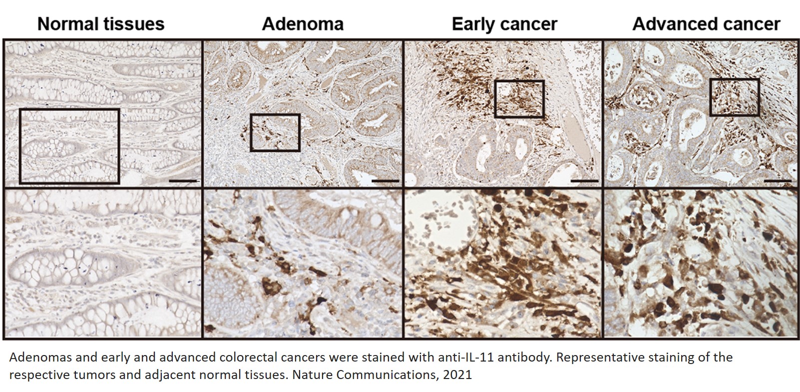 Interleukin 11 as a marker of colorectal cancer-associated fibroblasts