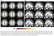 Neuroimaging of depression with diffuse optical tomography 