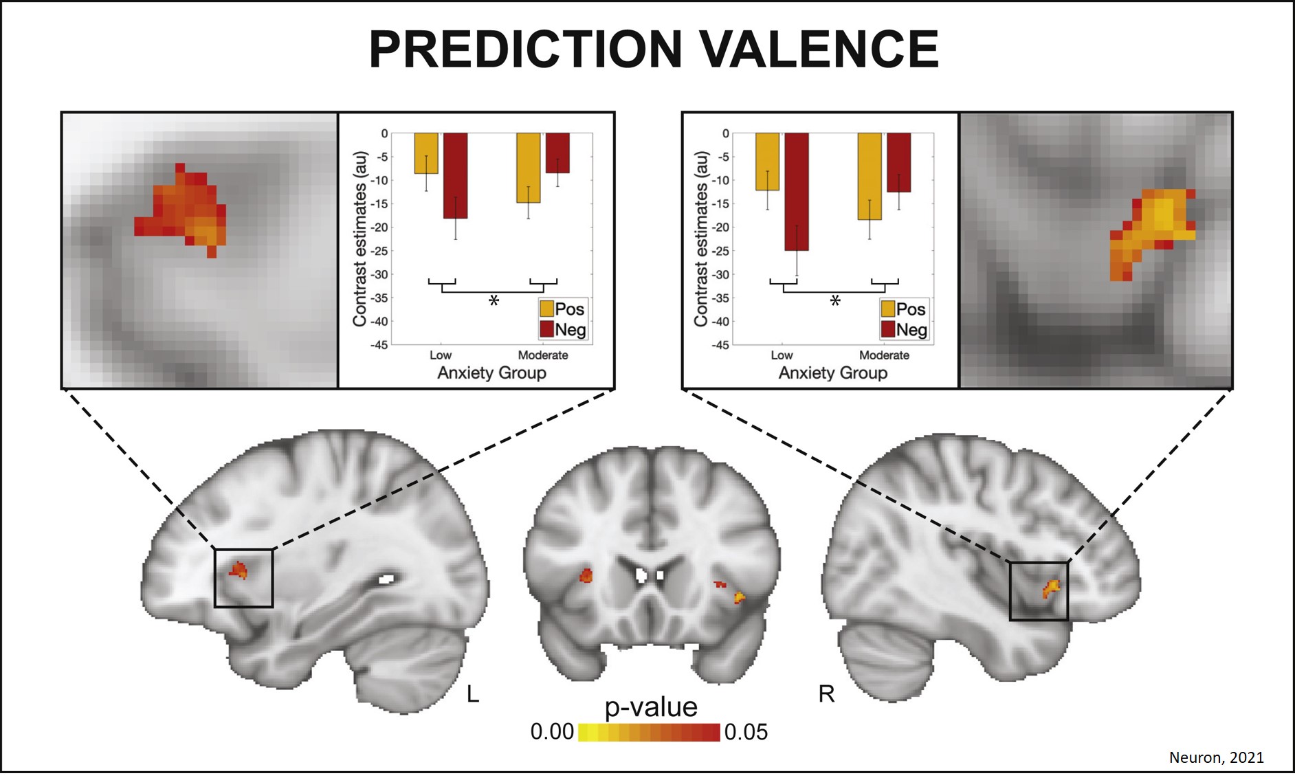 Higher anxiety influence body perception