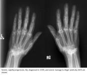 Gene regulating severity of tissue damage caused by rheumatoid arthritis discovered 