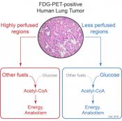 Metabolic Heterogeneity in Human Lung Tumors