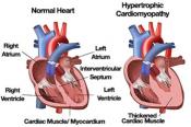 Preventing sudden cardiac death 