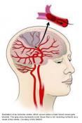 Diabetes drug may prevent recurring strokes