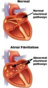 Yoga improves quality of life in patients with atrial fibrillation