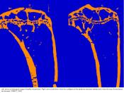 Link between psoriasis and general bone loss