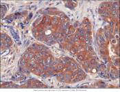 Breast cancer tumor growth is dependent on lipid availability