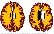 Obesity associated with increased brain-age from mid-life