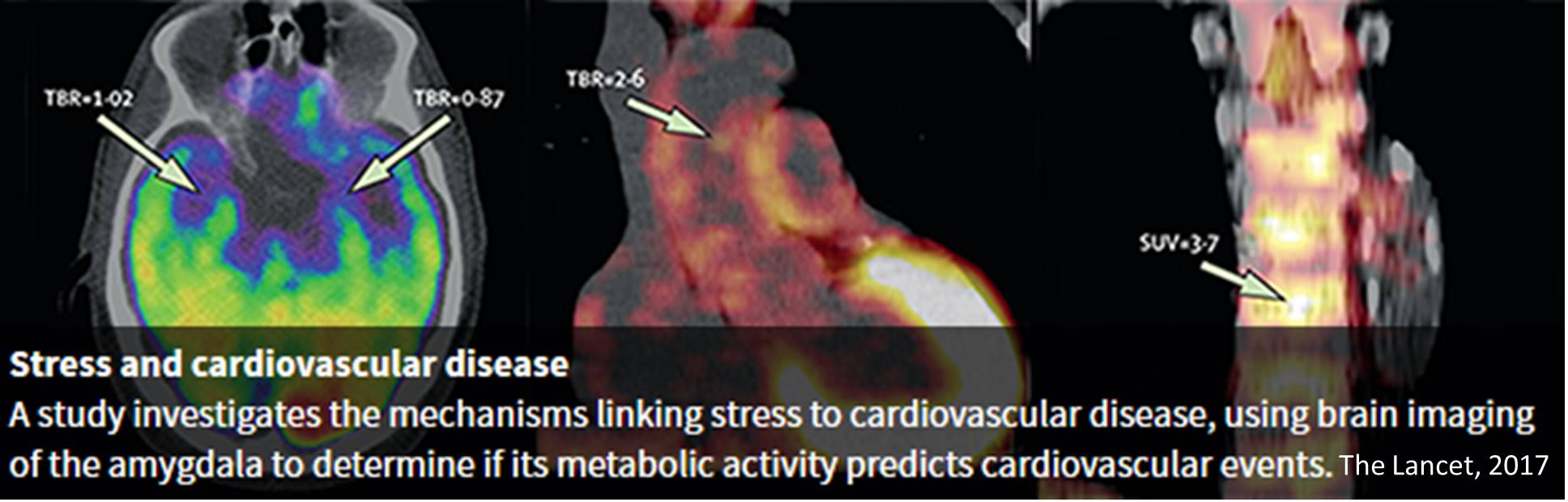 How stress may lead to cardiovascular disease &amp; stroke