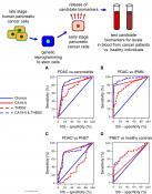 Detection of early pancreatic cancer blood markers!