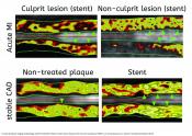 A noninvasive measure to identify dangerous blood vessel plaques