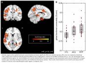 Brain recovery longer than clinical recovery among athletes following concussion
