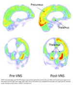 After 15 years in a vegetative state, nerve stimulation restores consciousness