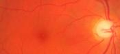 A small peptide blocks abnormal blood vessel growth in retinal disease