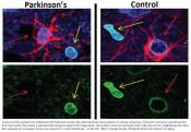 New way to treat Parkinson&#039;s disease