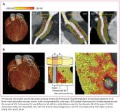 Novel imaging biomarker to help predict coronary inflammation