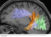White matter pathway and individual variability in human stereoacuity