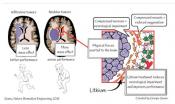 Solid stress from brain tumors cause neuronal loss, neurologic dysfunction