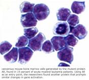  New target for acute myeloid leukemia identified