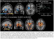 Structural difference in the brain region of young adults with addiction risk