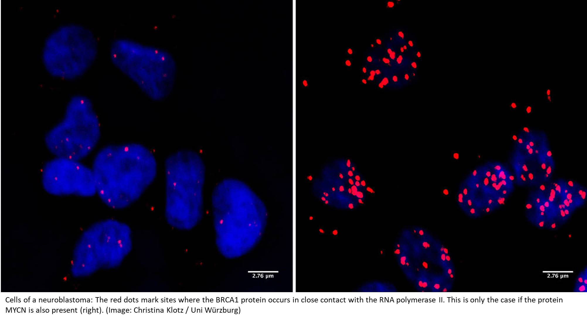 Protein BRCA1 keeps neuroblastoma stable