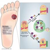 Wound healing problem in diabetes linked to certain bacteria