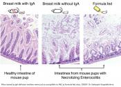 Breastmilk antibody protects preterm infants from deadly intestinal disease