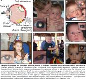 A smartphone app to detect early signs of eye disorders in children by parents