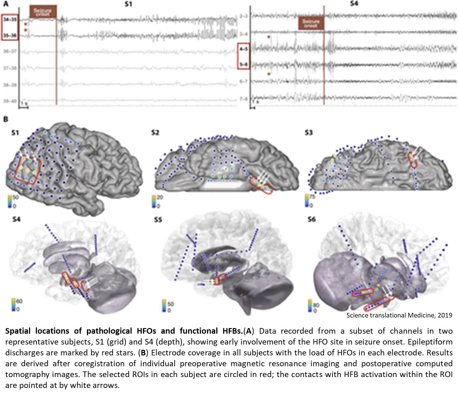 Epilepsy-associated cognitive disruption