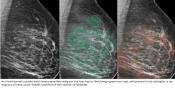 Radiologists &amp; AI Together Better at Detecting Breast Cancer