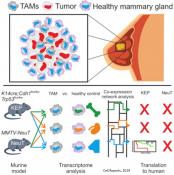 Macrophage transcriptome identifies aggressive breast cancer