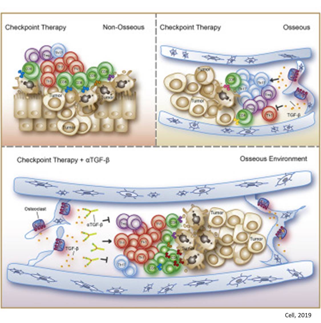 Prostate cancer bone metastases thwart immunotherapy by producing TGF-beta 