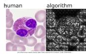 AI tool to detect blood cells in leukemia!