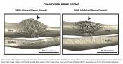 Bone fracture healing &nbsp;require nerve signaling pathway
