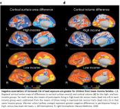 Lead exposure linked to decreased brain volume in adolescents