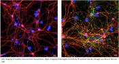 &#039;Natural killer&#039; cells could halt Parkinson&#039;s progression