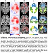 Artificial intelligence can accurately predict risk, diagnose AD