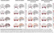 Beta-amyloid facilitates the spread of toxic tau in Alzheimer&#039;s disease