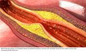 Unregulated smooth muscle cell growth may drive atherosclerosis