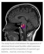 Stroke-related brain blood vessel abnormality linked to bacteria