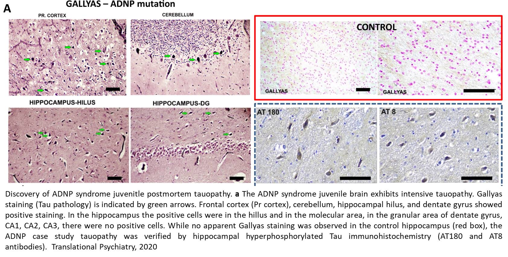 Tauopathy in the young autistic brain