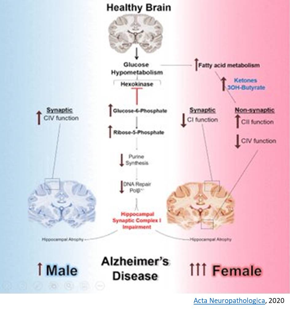 Brain glucose may increase women&#039;s risk of Alzheimer&#039;s