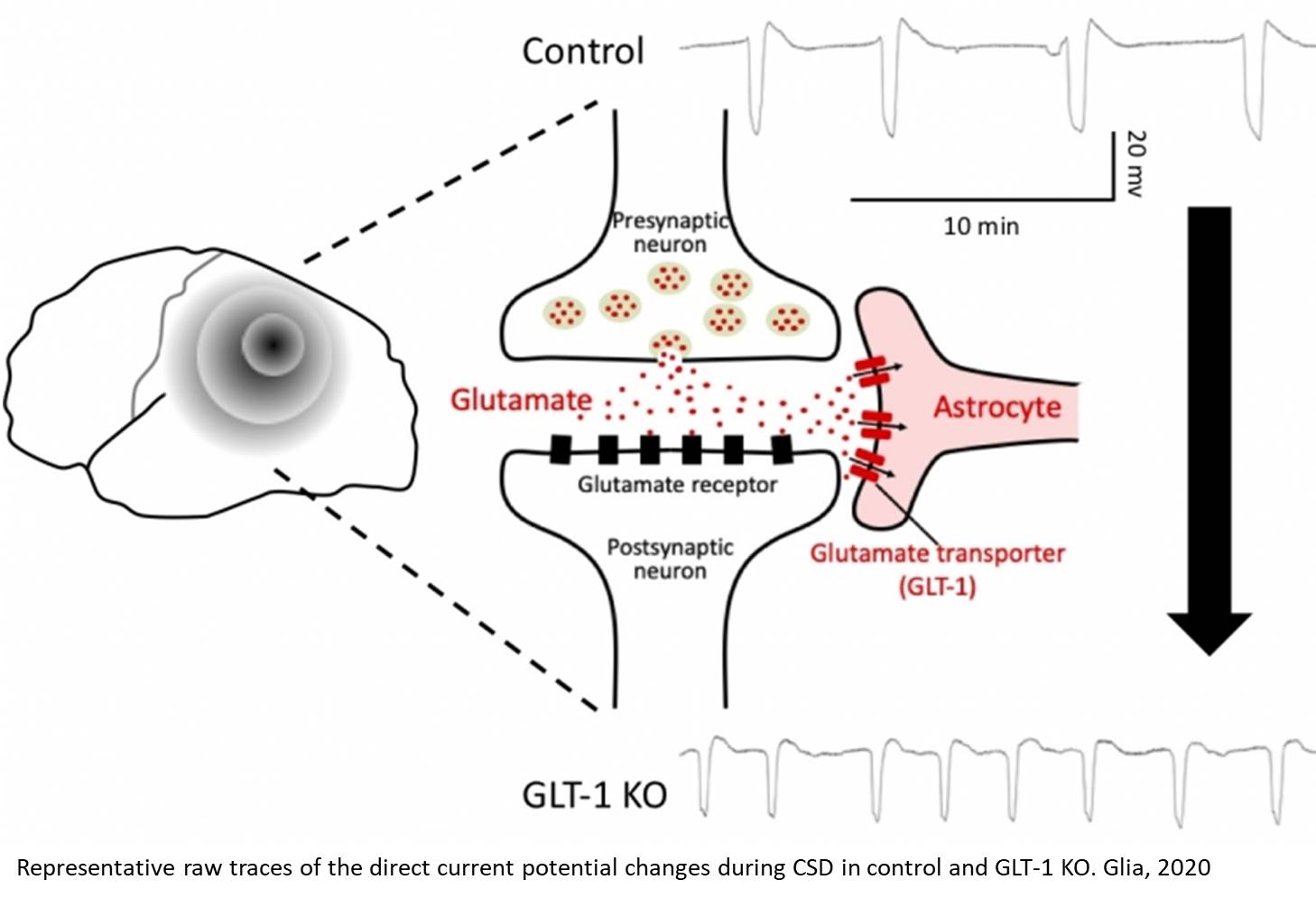 Glial glutamate transporter implicated in spreading cortical depression resulting in migraine 