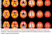 Depression - Brain scan